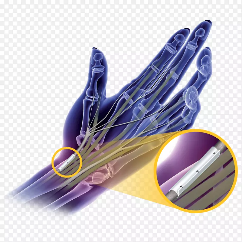 腕管综合征手术神经手部