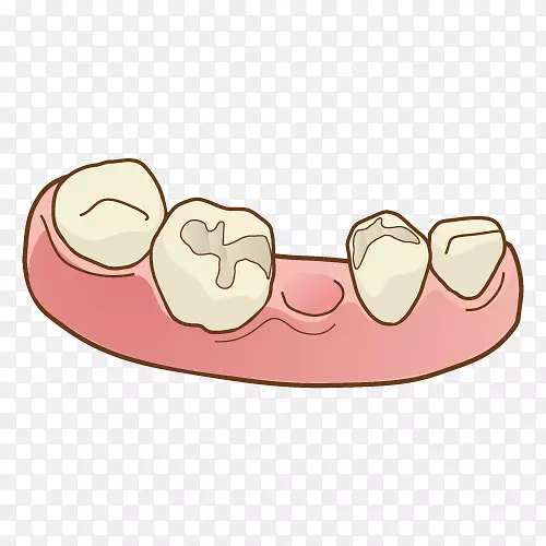 牙科牙桥义齿人工歯-桥