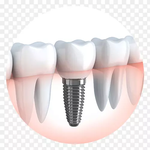 牙种植体美容牙科外科-萨尼牙科集团