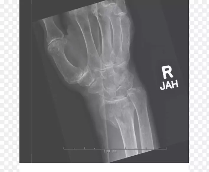 X线骨折桡骨远端骨折肩臂骨折