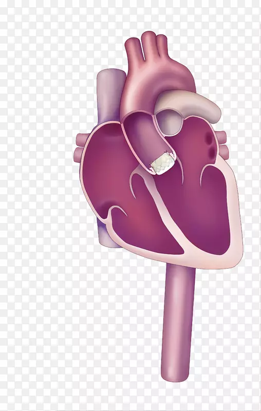 经皮主动脉瓣置换术主动脉瓣狭窄心脏瓣膜-心脏