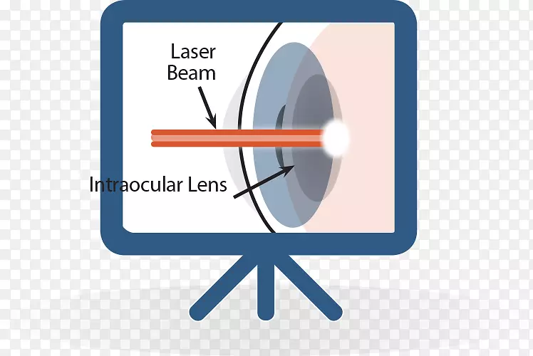 白内障手术激光透镜-激光束
