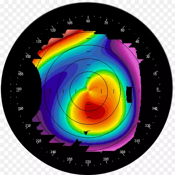 角膜地形图圆锥眼