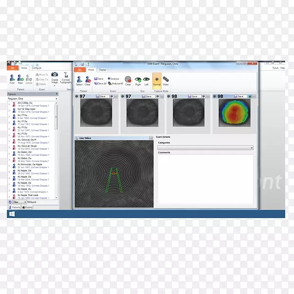 角膜地形图测量师计算机软件矫形学