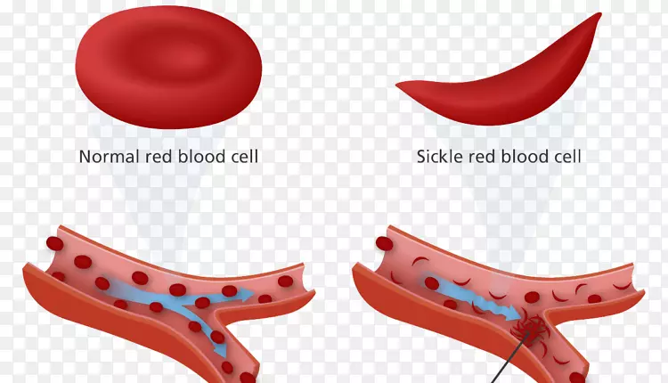 镰状细胞病贫血镰状细胞特性红细胞-世界健康日
