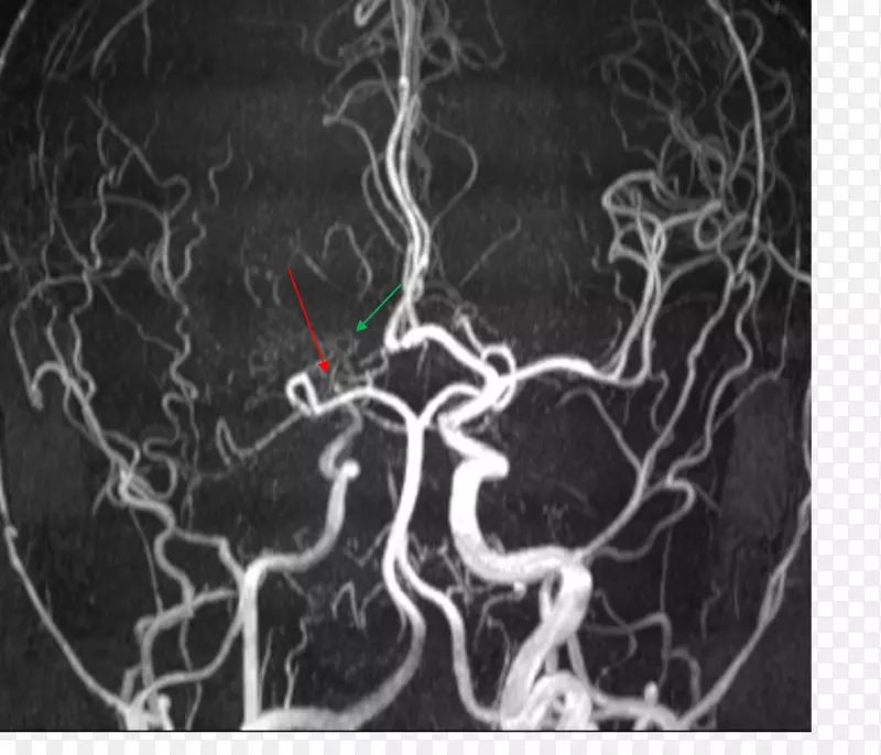 医学影像学磁共振血管造影烟雾病磁共振成像大脑后动脉
