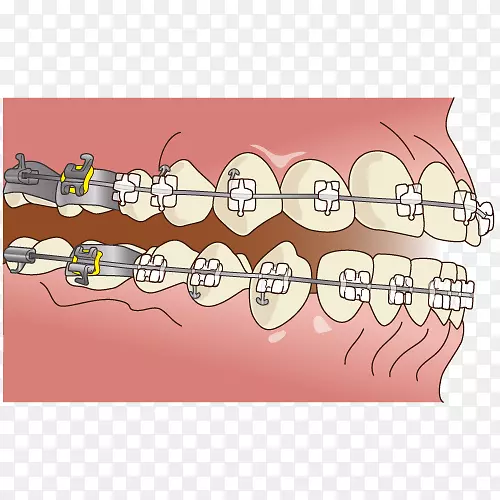 牙科矯正歯科牙套.牙套