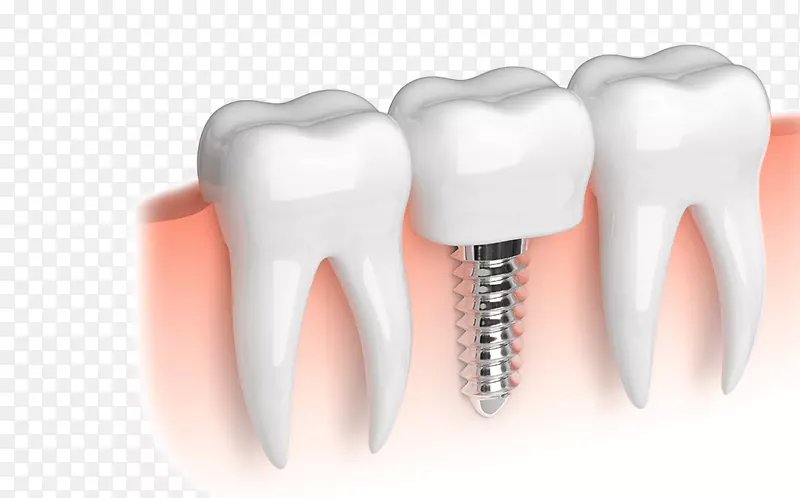 牙科种植体牙科修复义齿.健康
