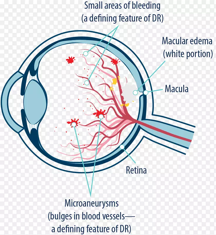 黄斑水肿糖尿病视网膜病变视网膜黄斑变性糖尿病眼
