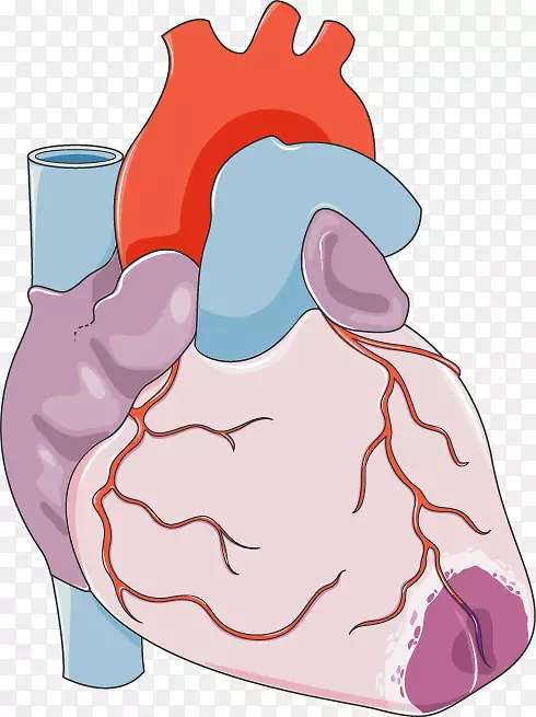 心脏急性心肌梗死冠状动脉旁路手术心血管疾病-心脏
