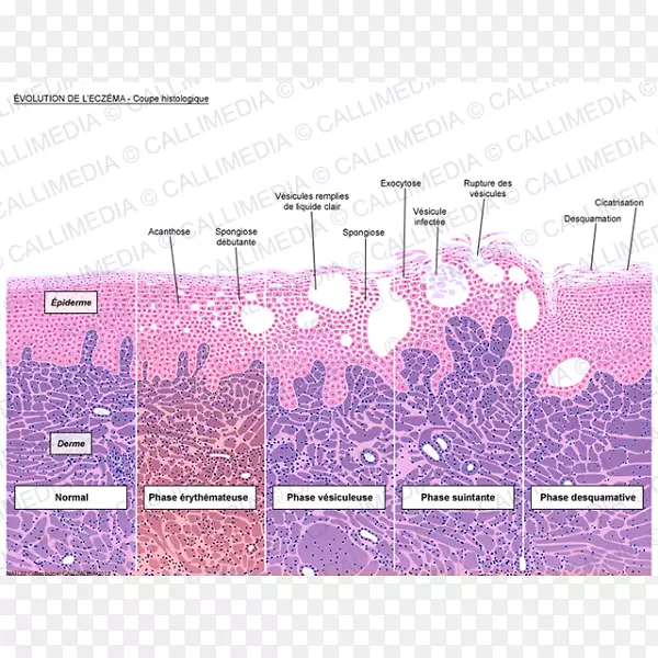 组织学，皮炎，角质形成细胞，组织学，湿疹