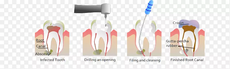 牙髓治疗根管牙科-根管