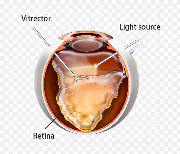 视网膜脱离玻璃体切除术