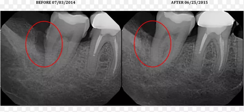 激光辅助新附着手术牙周病