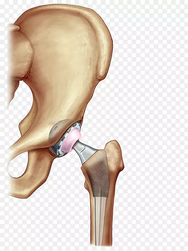 髋关节置换术膝关节置换术-髋关节镜检查