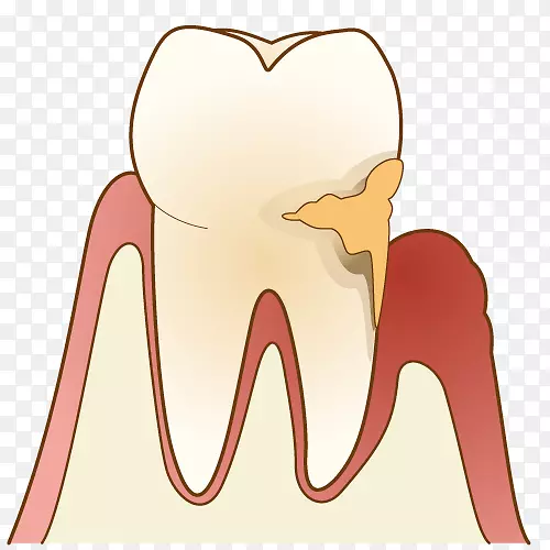 牙周病牙龈歯科牙医牙菌斑牙刷