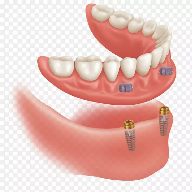 牙科种植义齿牙科基牙弓