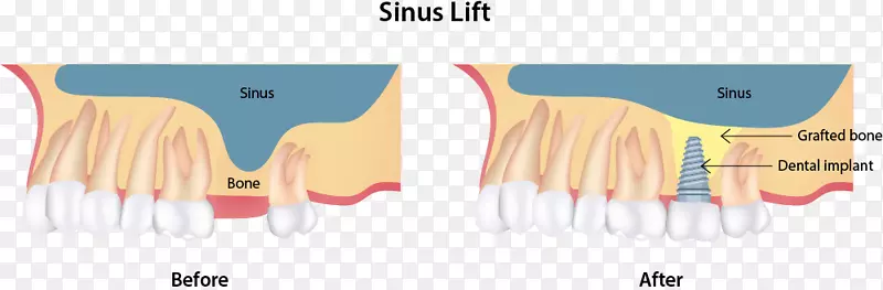 鼻窦提升牙种植体牙科手术-鼻窦提升