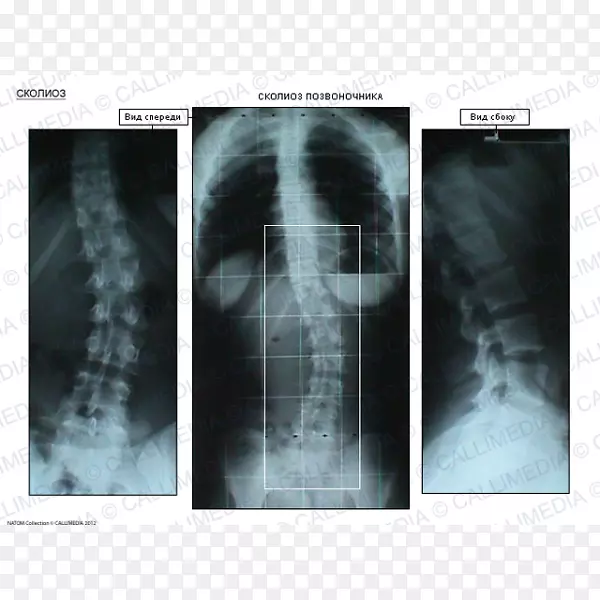 X线放射学医学影像X线摄影脊柱侧凸