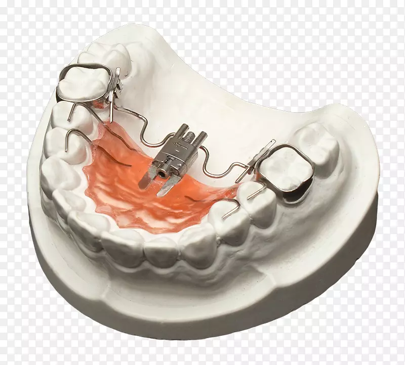 牙颌正畸技术上颌
