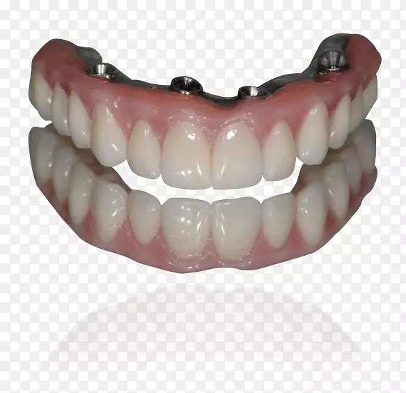全对4牙种植义齿.牙科植入物