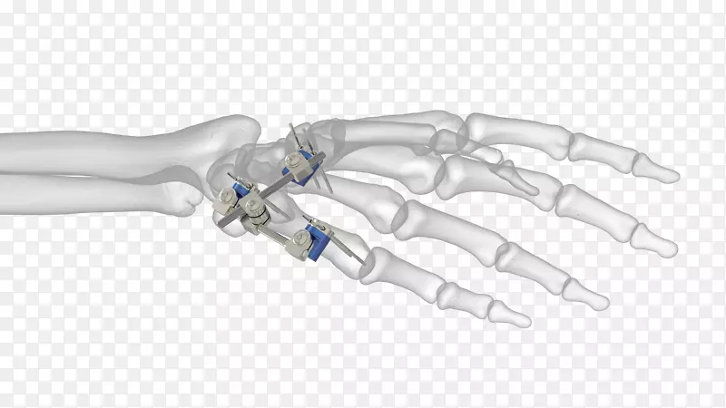 拇指正畸中行外固定桡骨远端骨折
