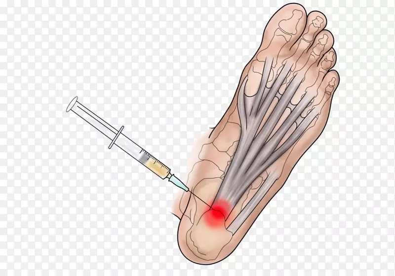 拇指足底筋膜炎富血小板血浆疗法踝关节