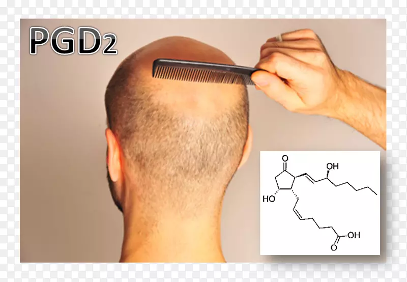 脱发前列腺素D2头皮