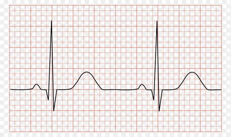 心电图QRs复合窦性心律失常-心脏