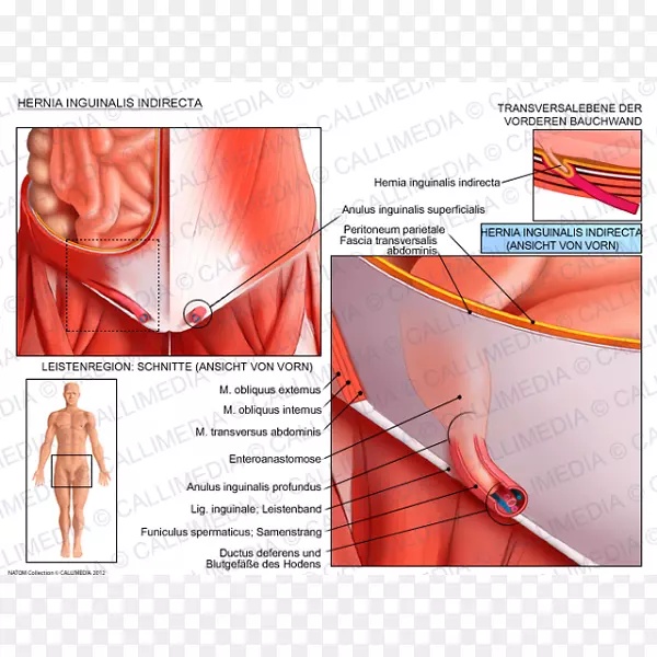 腹股沟疝，腹股沟外斜肌，腹股沟管，腹内斜肌