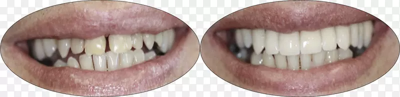 牙列畸形DDS专业牙科协会牙冠牙科-牙冠