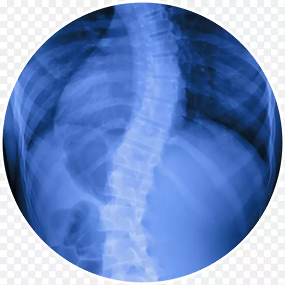 脊柱侧凸手术治疗背痛