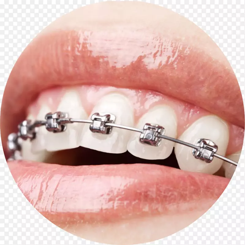 正畸牙床牙科达蒙系统牙科护理