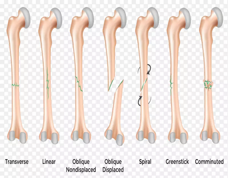 骨折格林斯克骨折应力骨折髋部骨折
