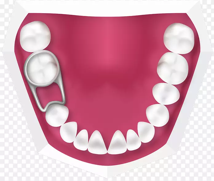 牙乳牙，正畸，固牙，牙科-儿童