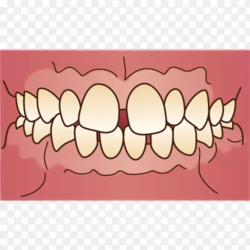 Prognathism反牙合错牙合歯科牙医-牙套