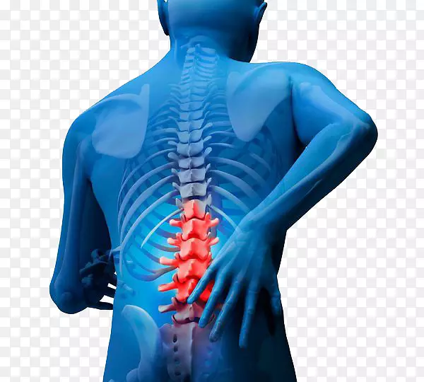腰背痛脊柱腰椎融合术