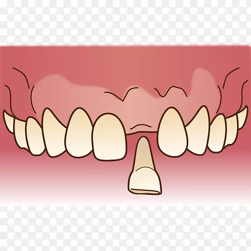 審美歯科牙科假牙牙科技师-牙科桥