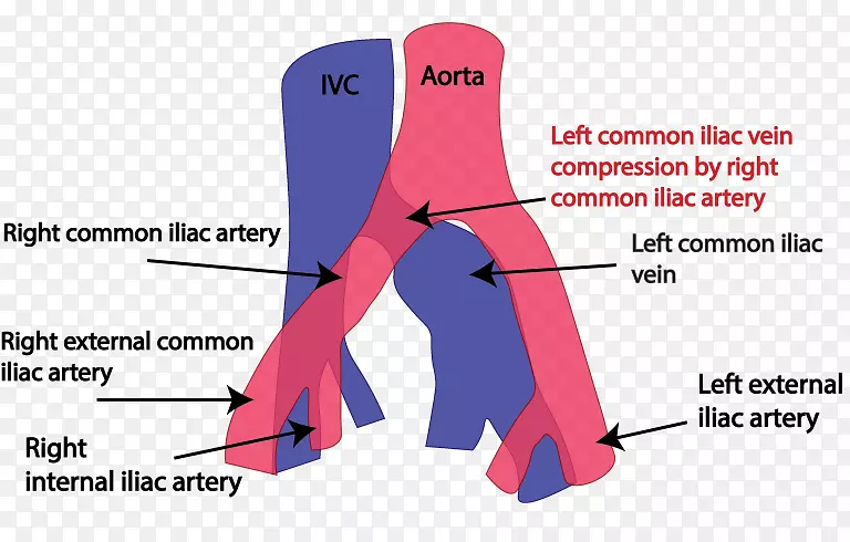 髂总静脉-瑟纳综合征髂总动脉髂股韧带