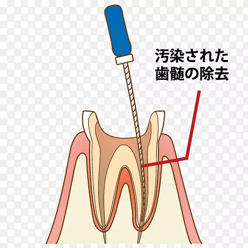牙齿牙医歯科根管治疗-说明
