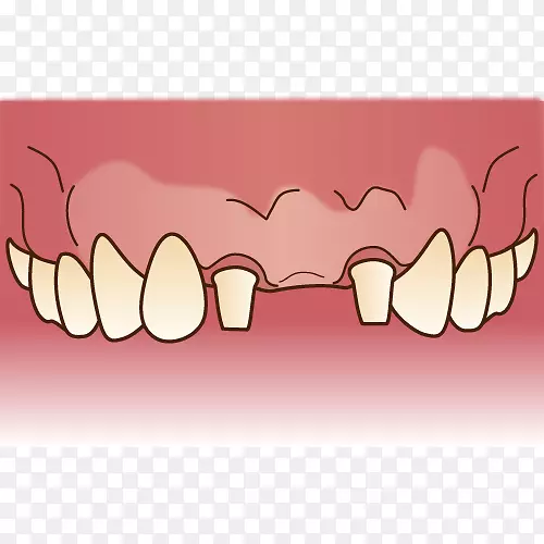 牙齿义齿牙医歯科桥