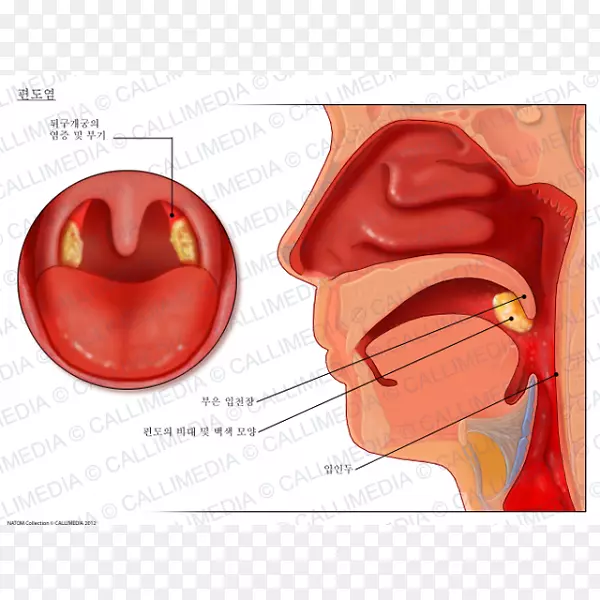 扁桃体炎耳鼻喉科口咽癌-鼻