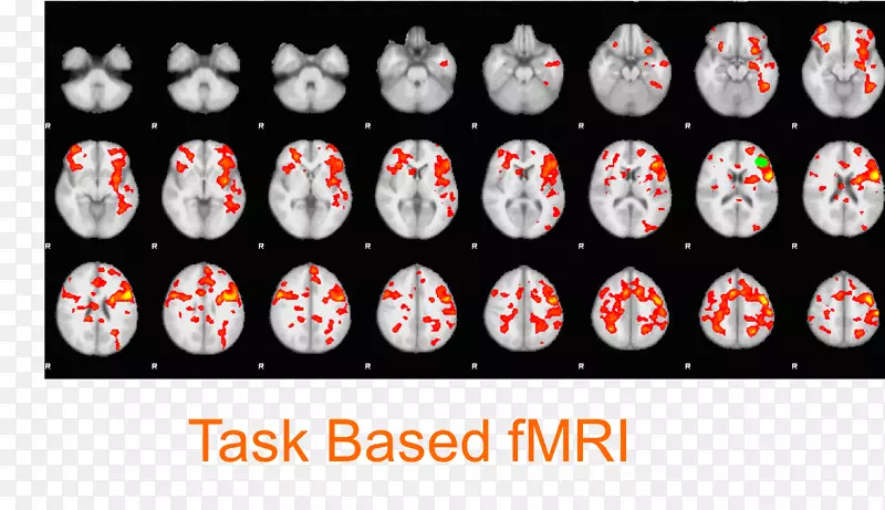 功能性磁共振成像脑默认网络功能神经成像-脑