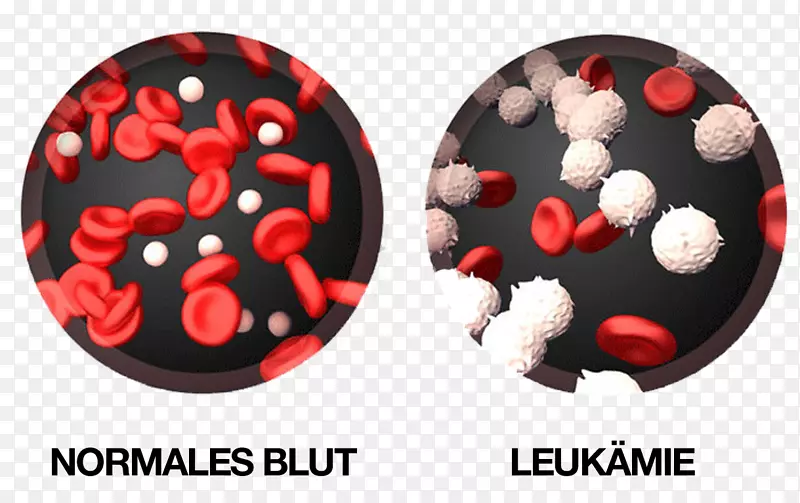 慢性粒细胞白血病白血球