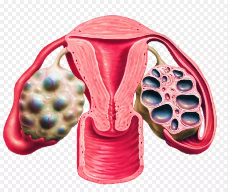 多囊卵巢综合征卵巢囊肿病手术工具