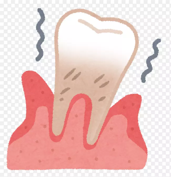牙周病牙龈牙医歯科-牙周