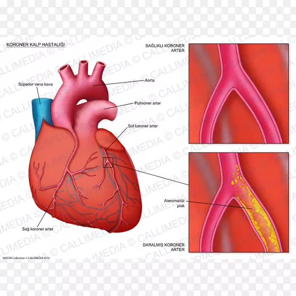 冠心病、冠状动脉、心脏病、心血管疾病-心脏