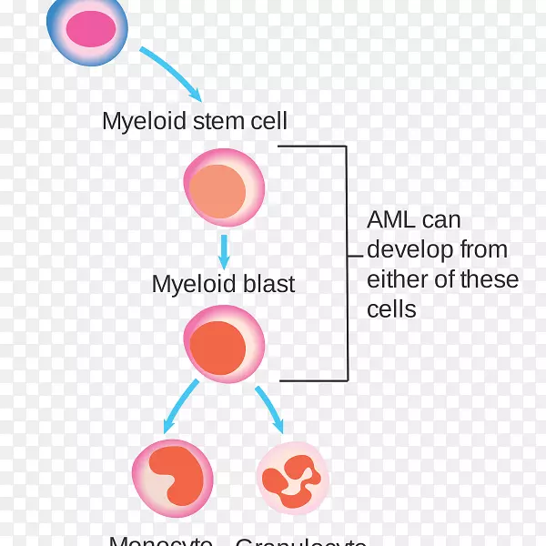 白细胞急性髓系白血病-血液