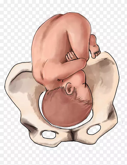 胎位分娩，婴儿臀位分娩-妊娠