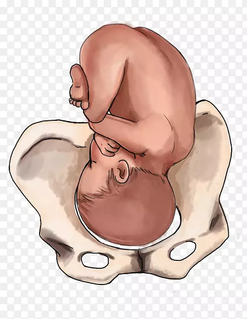 分娩，胎儿位置，婴儿臀位，出生-妊娠